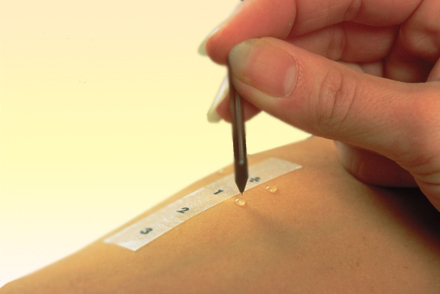 Кожные пробы Пробы на аллерген