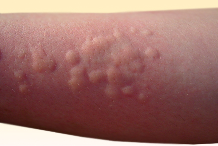 Крапивница и появление волдырей - признак аллергии Крапивница