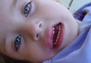 Как выглядит отек Квинке на губе у малыша Отек Квинке на губе у ребенка