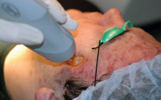 Лечение лазером Лечение псориаза лазером