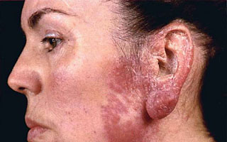 Риск рубцевания Противопоказания