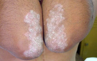 Псориазом страдает 2% населения планеты Причины появления псориаза