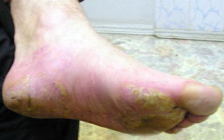 Нарушение кератинизации Причины болезни