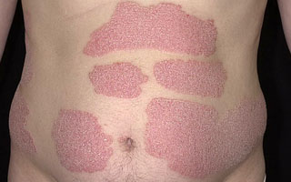 Вульгарная (бляшечная) форма Виды болезни