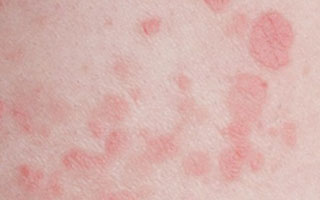 Розово-красный цвет сыпи Формы болезни