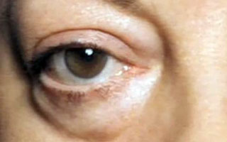 Отек облости вокруг глаз
