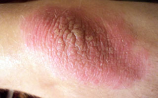 Экзема на локтях Экзема