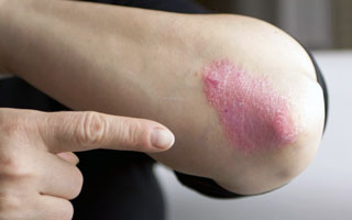 Локализация экзематозных высыпаний на локте Причины болезни