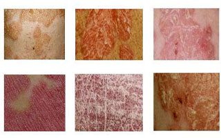 Для борьбы с любыми формами псориаза Рекомендации