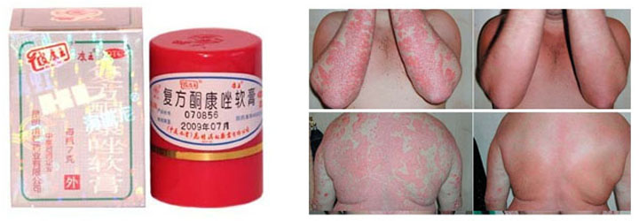 Препарат "Король кожи" до и после применения Препарат "Король кожи"