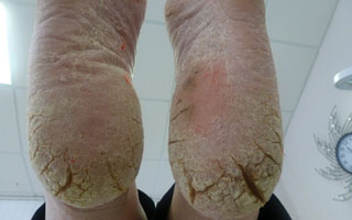 Микотическая экзема на стопах Микотическая экзема