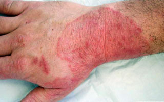 Очаг поражения на руке Симптомы