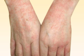 Покраснение кожи – первый симптом Раздражение на руках