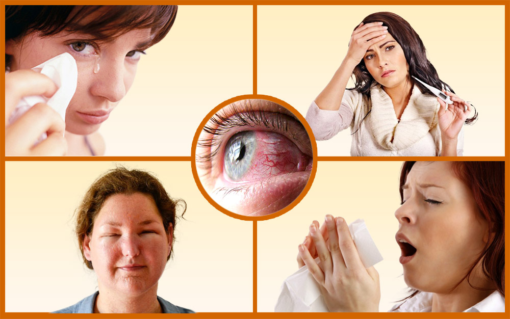 Проявления аллергии на нарощенные ресницы Симптомы аллергии