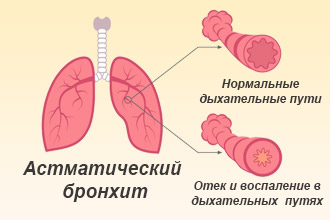 Астматический бронхит – частое осложнение при аллергии на пыль Астматический бронхит