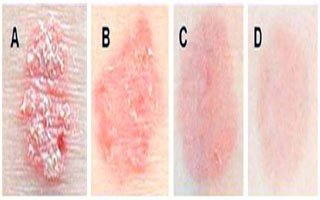 Результат применения "Нано-геля" Нано-гель от псориаза