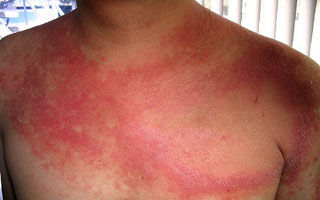 Псориатическая эритродермия Симптомы