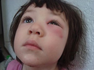 Как выглядит отек Квинке на глазу у ребенка Отек Квинке на глазу у ребенка