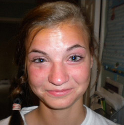 Как выглядит отек Квинке на веке Отек Квинке на нижнем веке