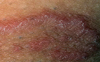 Паховый дерматит у мужчины Паховый дерматит