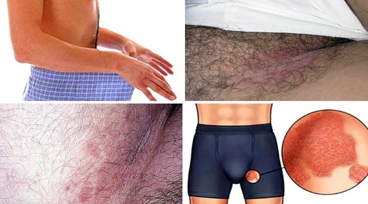 Виды и симптомы заболевания Проявления болезни