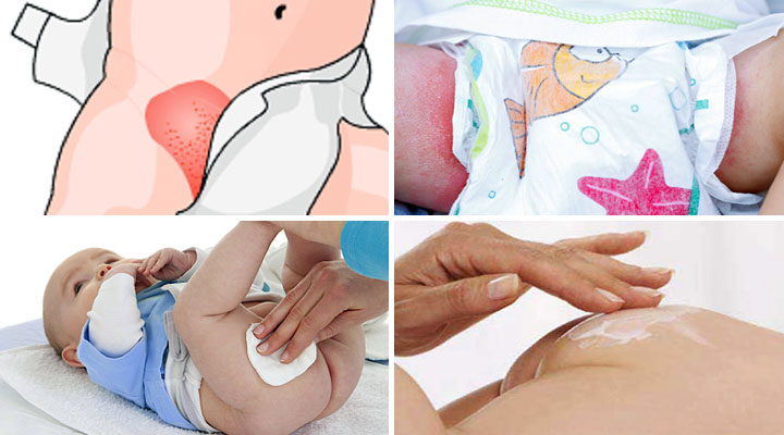 Проявления болезни и ее лечение Симптомы