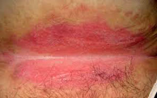 Воспаление кожи в области заднего прохода Симптомы