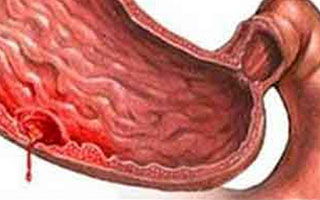 Язва желудка Противопоказания