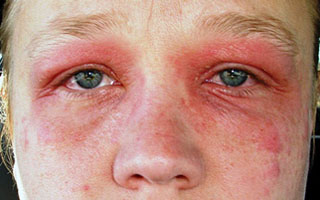 Отек глаз при аллергии Отек глаз