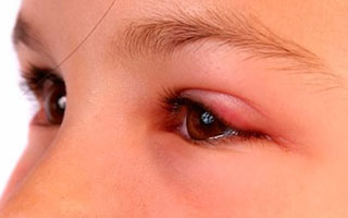 Отек, обусловленный пыльцевым аллергеном Аллерген