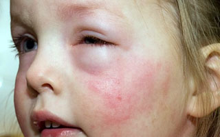 Отек Квинке Лечение отека Квинке