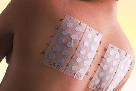 Провокационные тесты Тест на аллерген