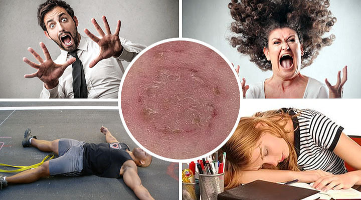 Причины, способствующие развитию экземы Причины психоэмоциональных нарушений