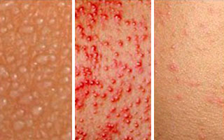 Пузырчатый дерматит Пузырчатый дерматит