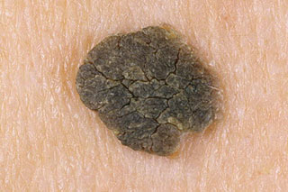 Ороговевший пигментированный очаг Коричневое шероховатое пятно на коже