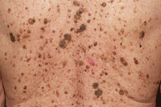 Множественные себорейные кератомы Множество коричневых пятен на коже спины