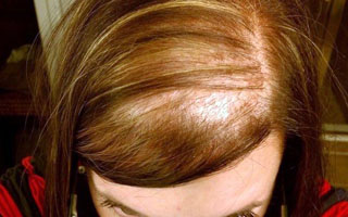 Развитие болезни по диффузному типу Выпадение волос