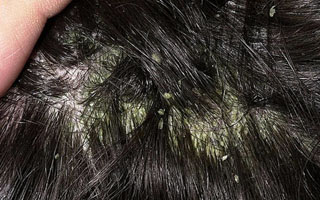 Себорейная экзема волосистой части головы Себорейная экзема