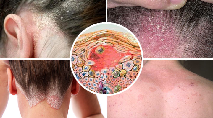 Экзематозные проявления и локализация высыпаний Симптомы заболевания