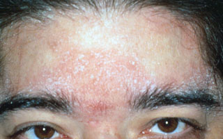 Себорейная экзема на лице Себорейная экзема на лице