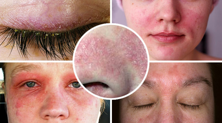 Локализация болезни в разных местах лица Проявления патологии