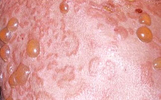 Сыпь Синдром Сенир-Ашера