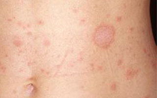 Начальная стадия развития болезни Симптомы болезни