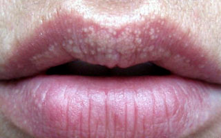 Внешний вид болезни