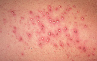 Признаки болезни