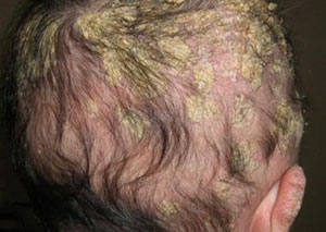 Плотные корочки Желтые чешуйки на голове у ребенка