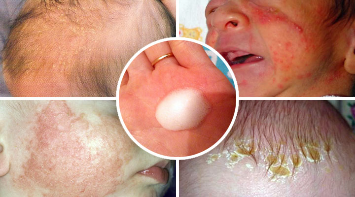 Шампунь "Мустела" при себорейном дерматите у детей Себорейный дерматит у детей