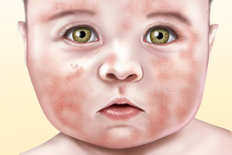 Сухая сыпь Сухая сыпь