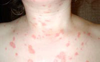 Проявление псориаза на шее Псориаз