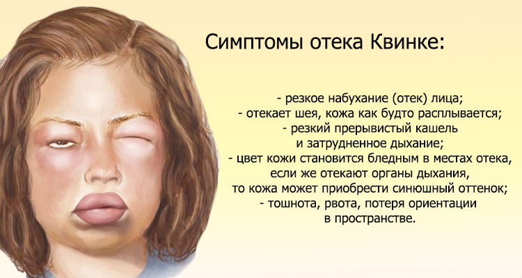 Отек Квинке Отек Квинке